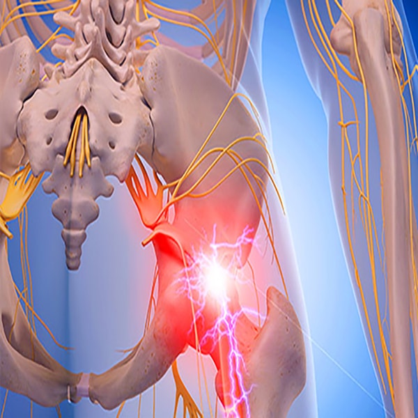  - image sciatic_nerve_pain on https://trydecompression.com